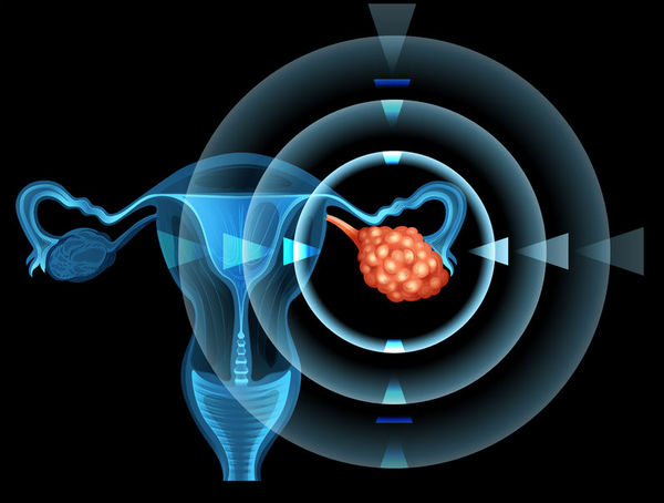 基因影响女性卵巢癌的治疗效果