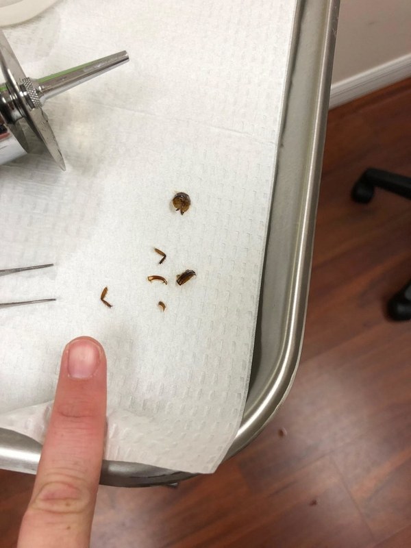 女子睡醒发现耳朵爬进蟑螂