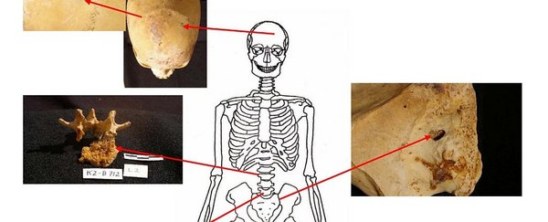 古埃及人的遗骨揭示当时癌症流行情况