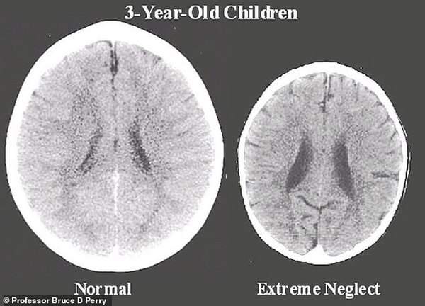 儿童大脑扫描图揭示疏于照管与用心养育的区别
