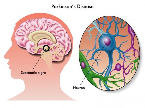 帕金森病被确证为免疫疾病