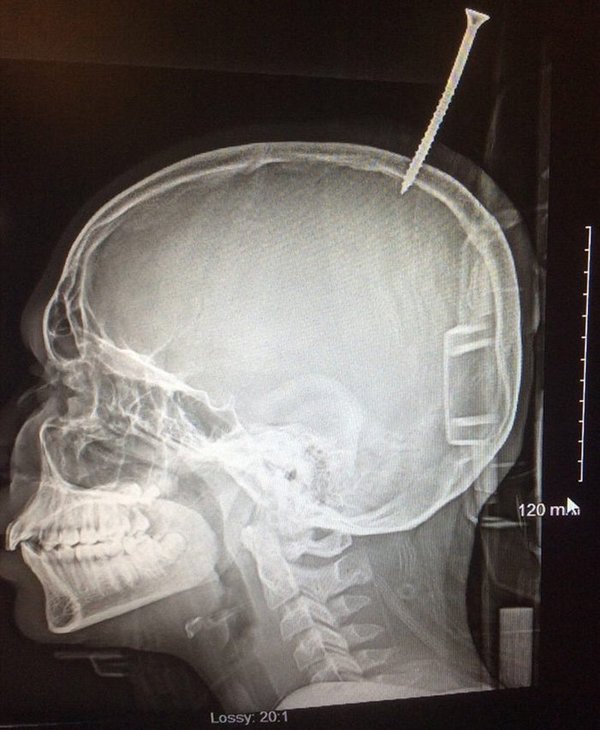 美国少年被15厘米螺钉插进大脑，离死神仅1毫米